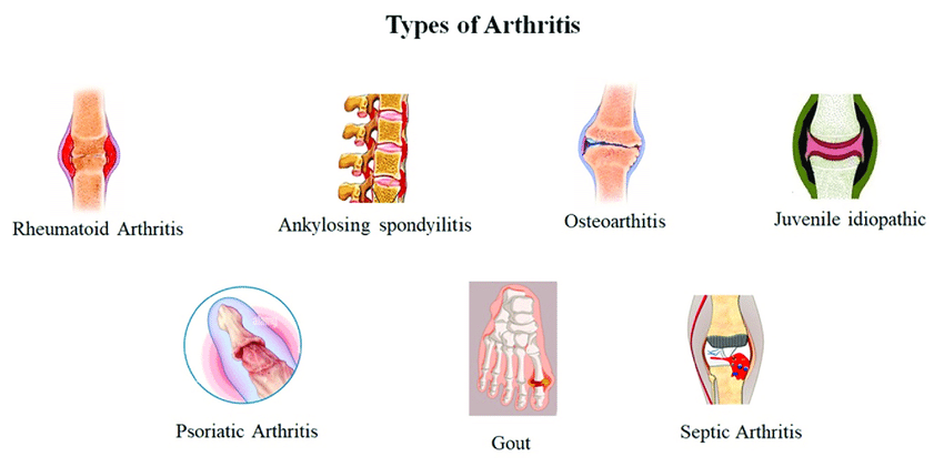 arthritis treatment in amritsar
