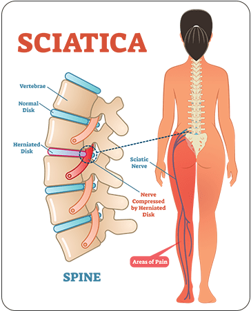 sciatica treatment in amritsar